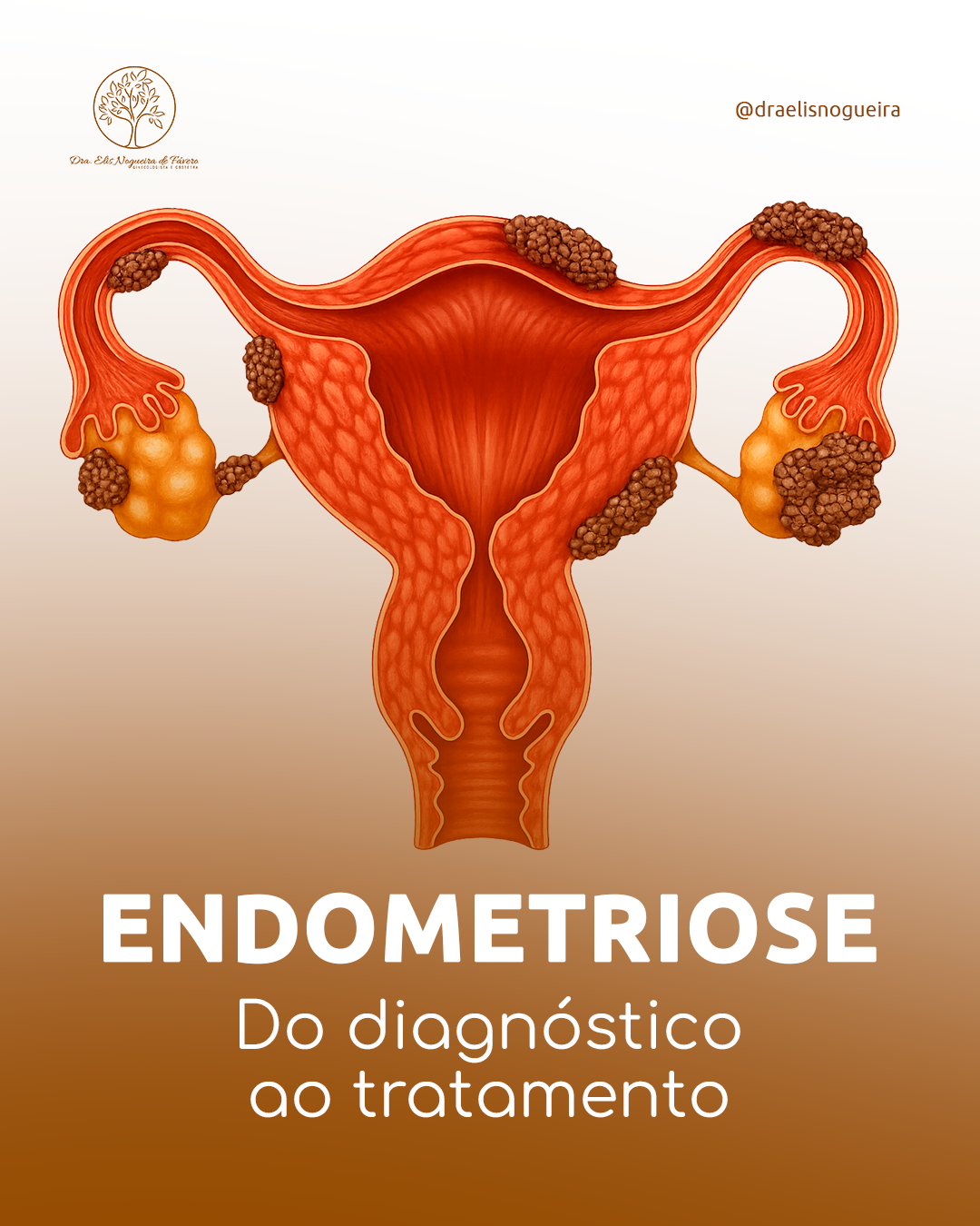Endometriose: Do diagnóstico ao pós-tratamento