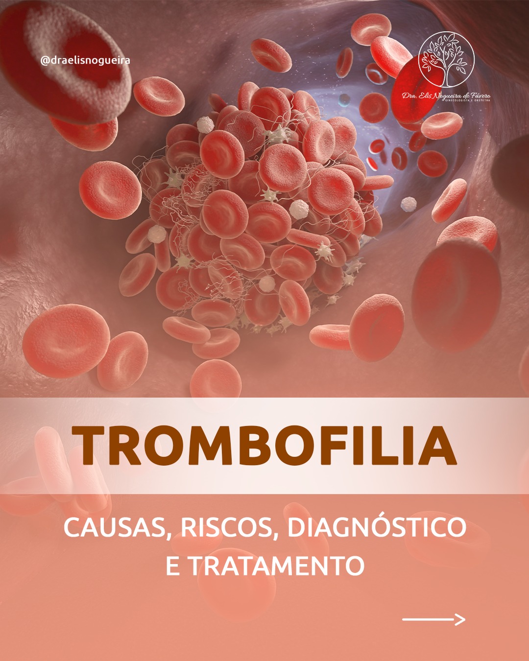 Trombofilia: causas, riscos, diagnóstico e tratamento